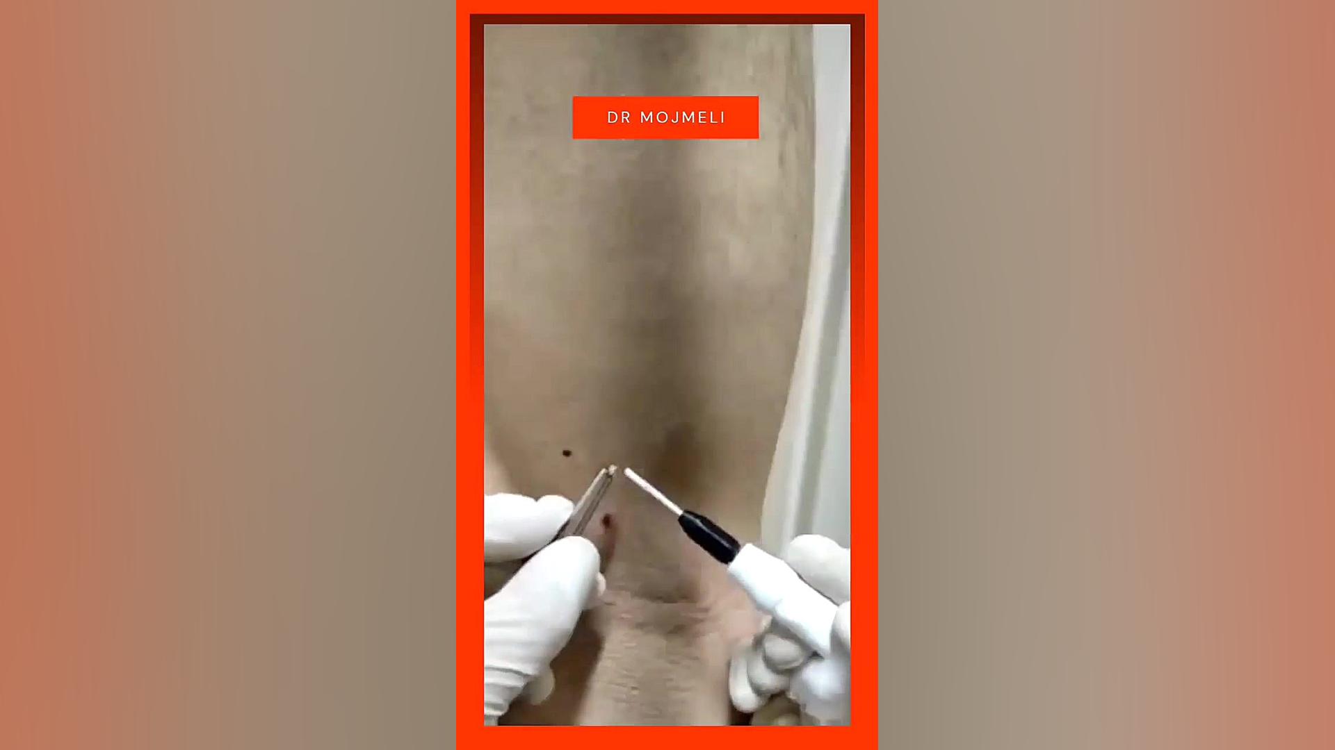 برداشتن skin tag (زائده گوشتی)...