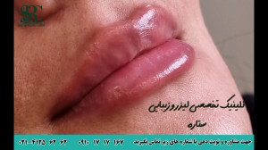 نمونه کارهای فیلر کلینیک تخصصی...