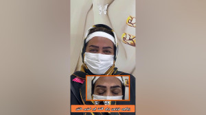 ویدیو کاشت ابرو دائمی | مرکز ک...