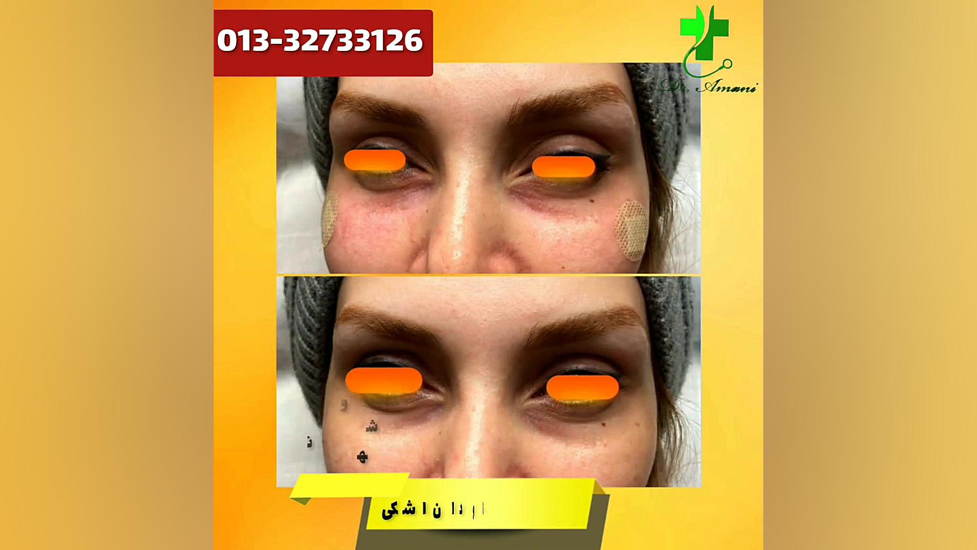 فیلر زیر چشم و ناودان اشکی