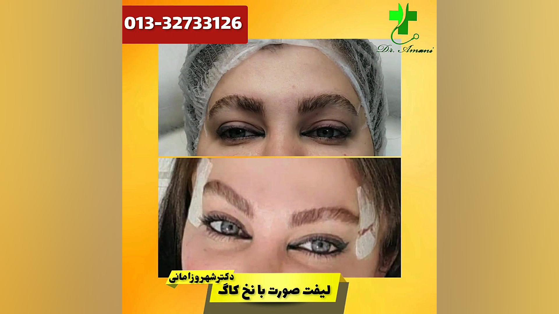 لیفت صورت دکترشهروز امانی