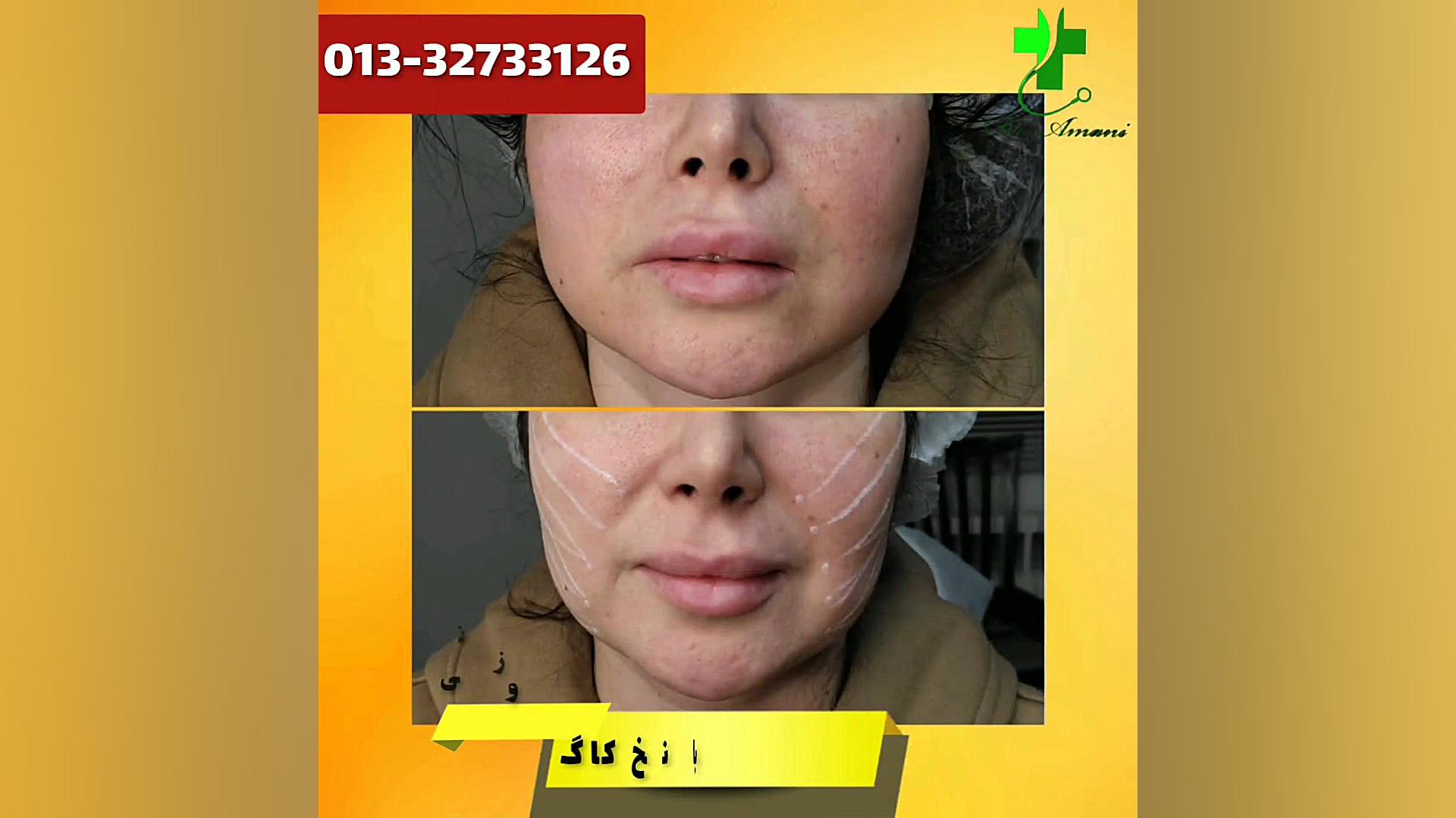 لیفت صورت با نخ کاگ دکترشهروز...