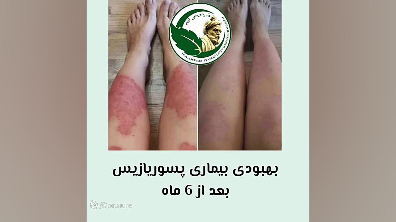 تنها روش درمان صد در صد پسوریا...
