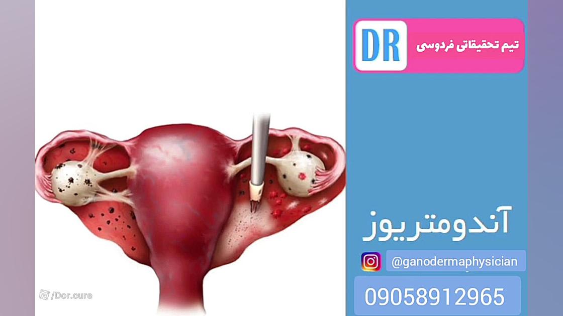 درمان گیاهی آندومتریوز بدون جر...