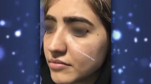 دو ماه بعد از تزریق چربی به صو...