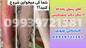 درمان خانگی پسوریازیس