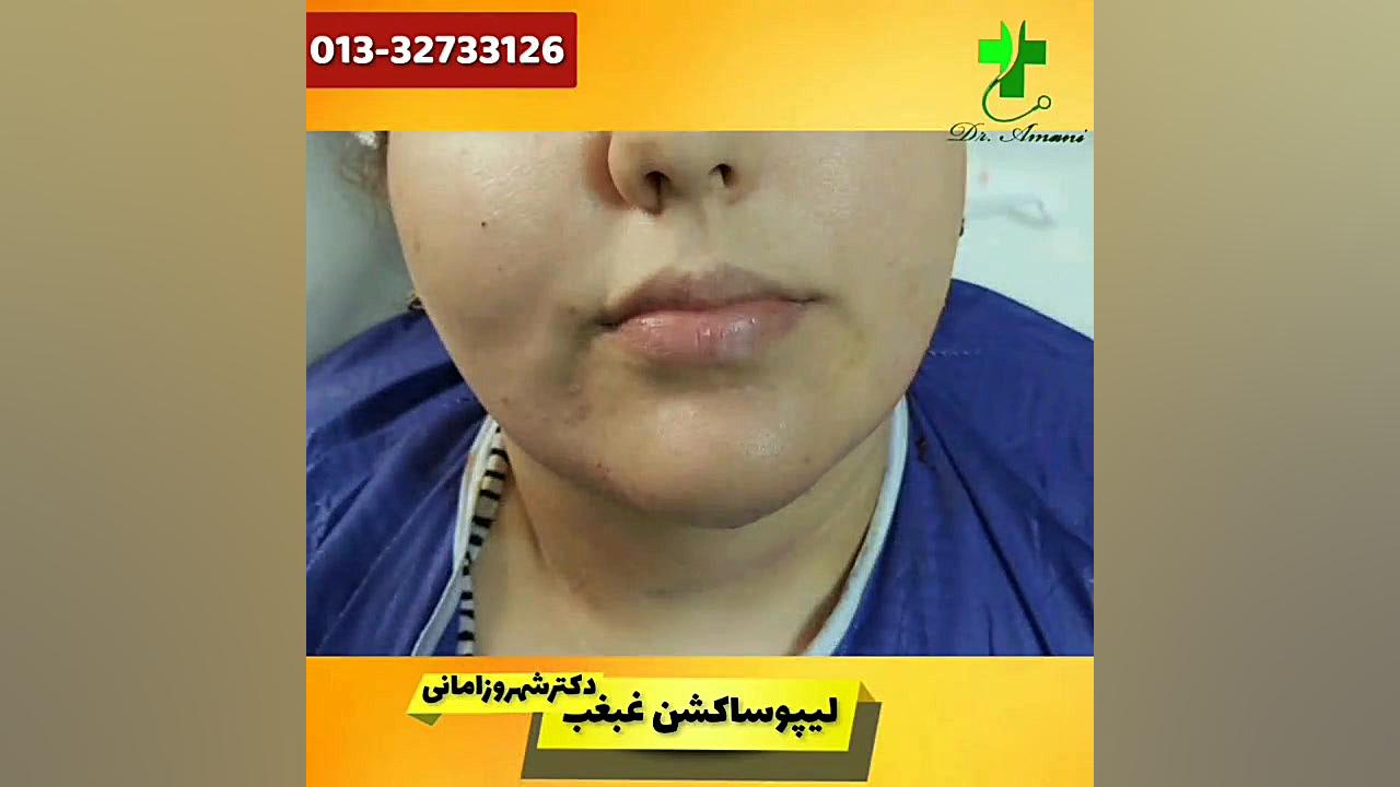 لیپوساکشن غبغب دکترشهروز امانی
