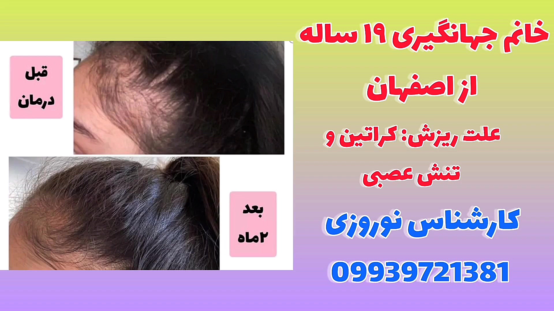 درمان ریشه ای ریزش مو