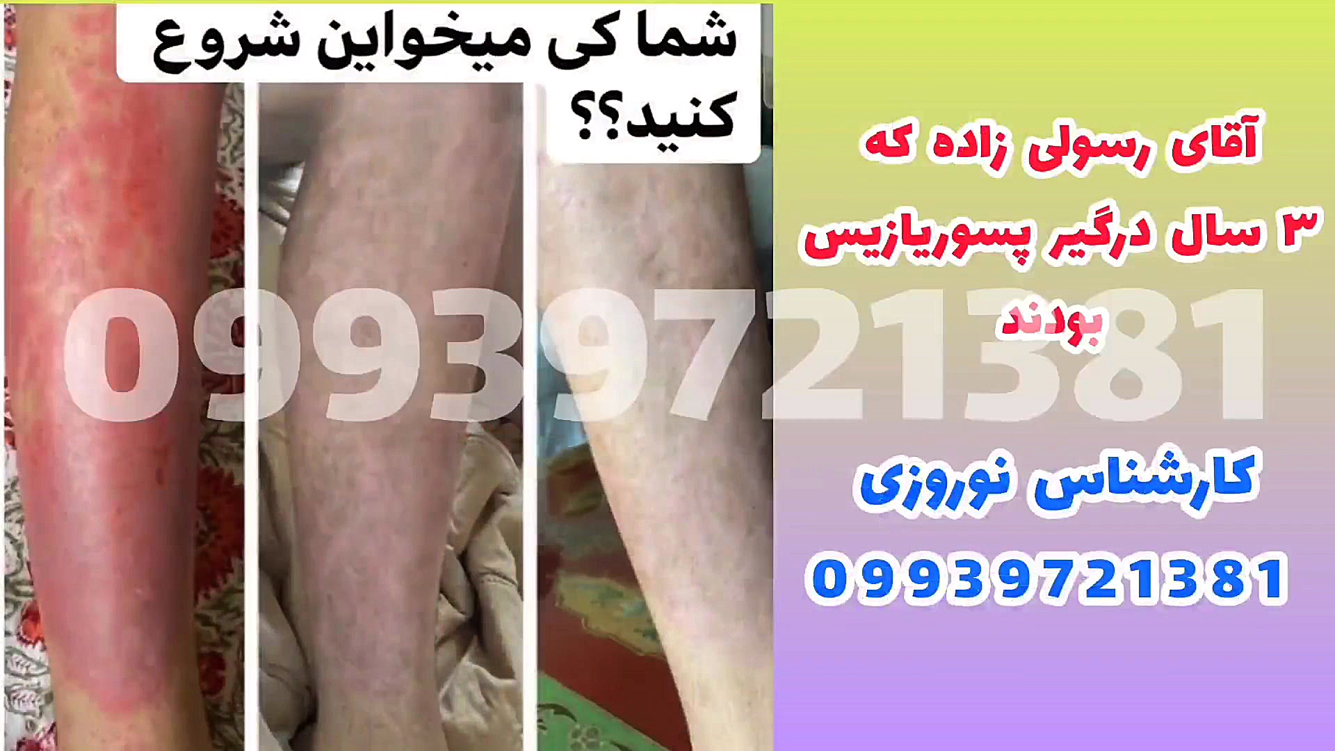 پسوریازیس در زنان