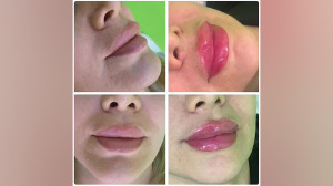 تزریق ژل لب روسی تخصصی توسط دک...