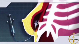 نحوه ی جایگذاری پروتز سینه