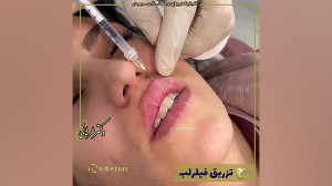 تزریق فیلر لب