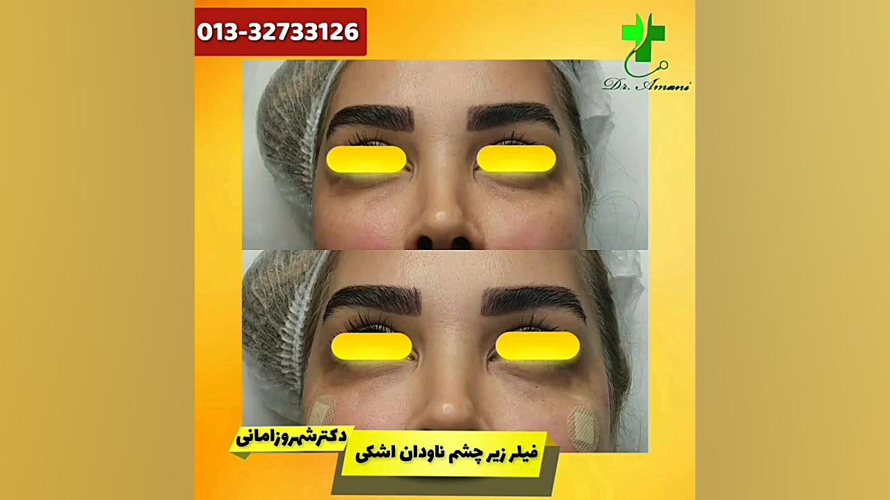 فیلر زیر چشم دکتر شهروز امانی