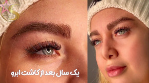 کاشت ابروی کلینیک ستاره ساعی