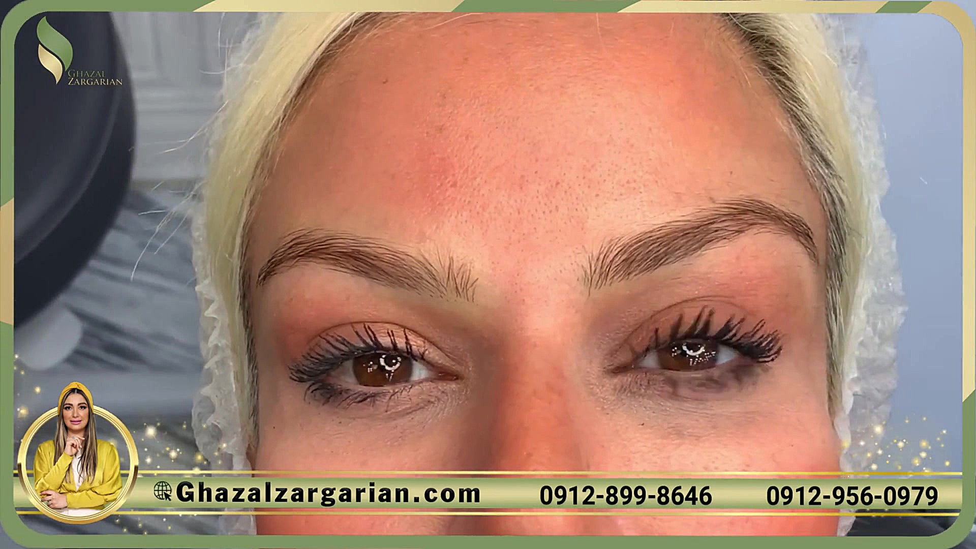 فیبروز میکروبلیدینگ ابرو در مر...