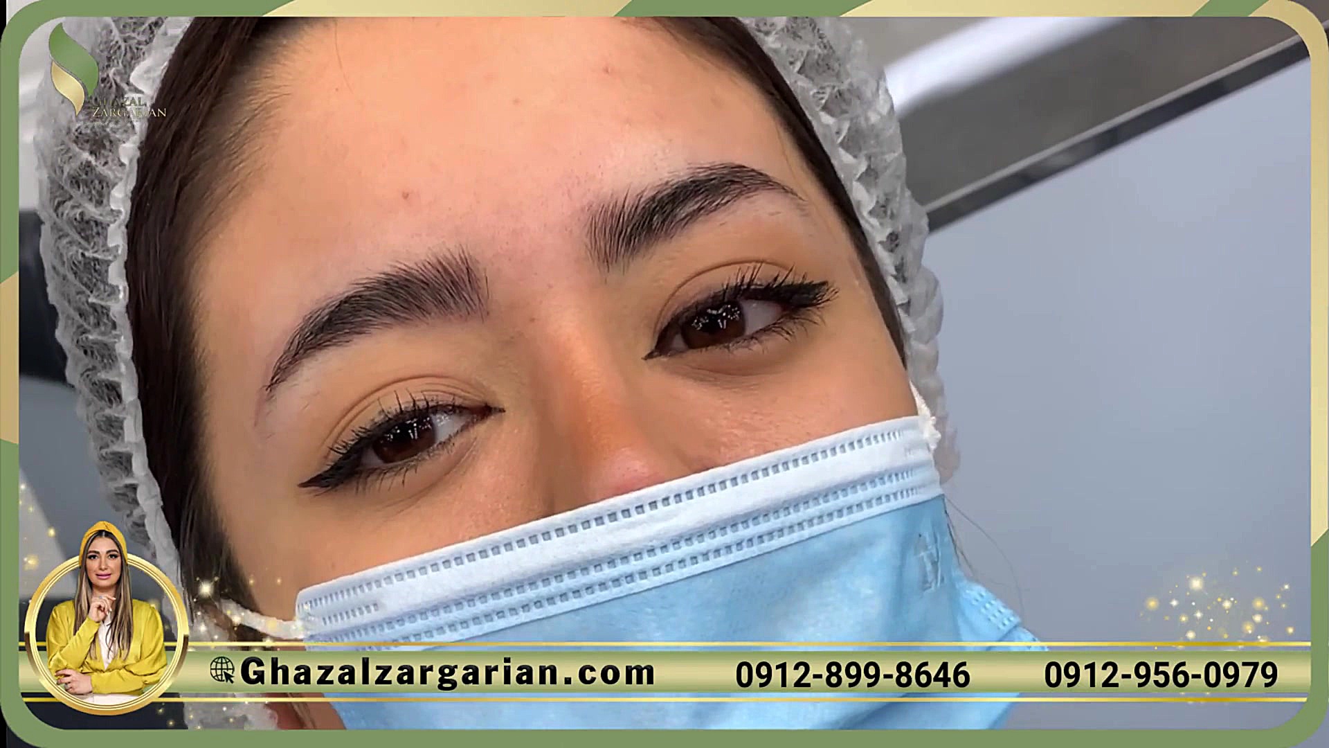 هزینه فیبروز ابرو