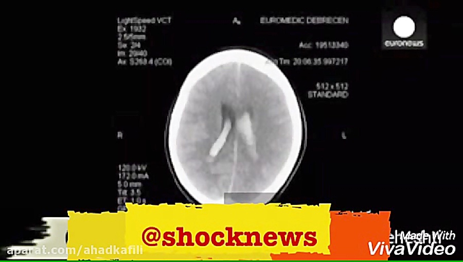 به دنیا آمدن نوزاد زنده از بدن...