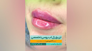 تزریق ژل لب روسی به روش دکترکر...