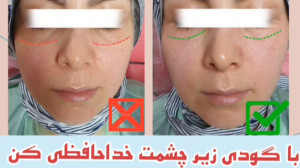 ️دیگه چشمات گود نیستن️