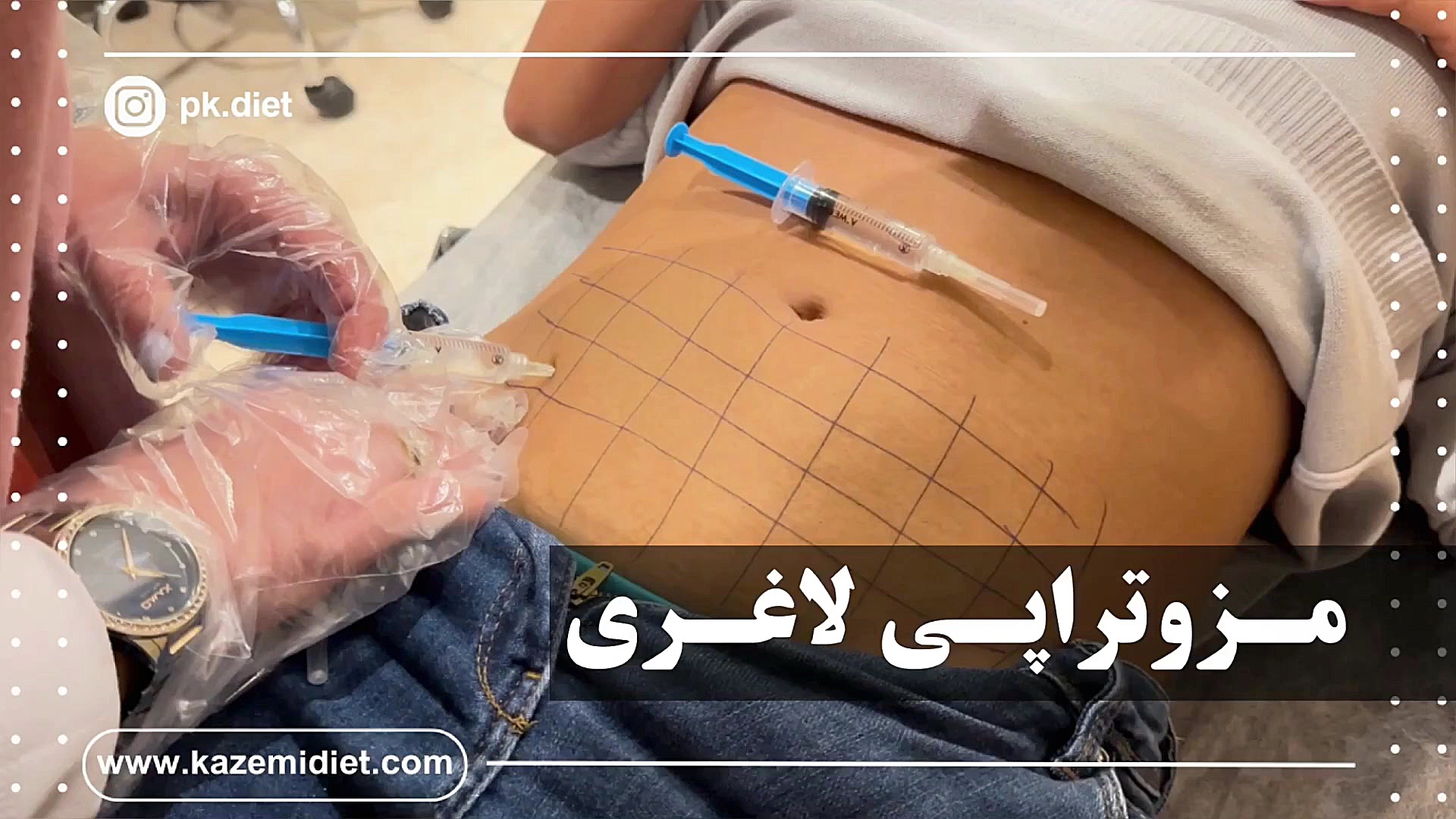 عکس قبل و بعد عمل لیپو ابدو+عکس لیفت شکم بدون جراحی+هزینه برداشتن چربی شکم بدون جراحی+فیلم دستگاه لاغری شکم