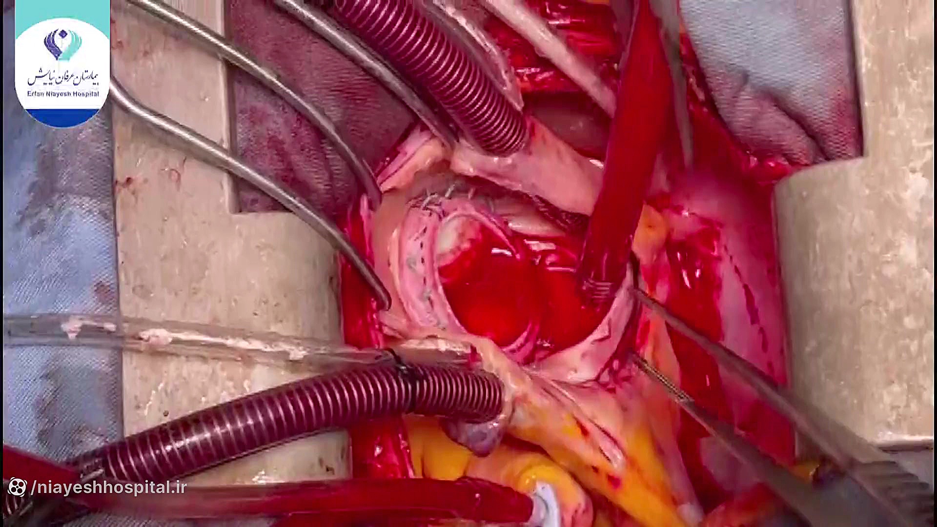 عمل جراحی تعویض دریچه قلب  ترم...