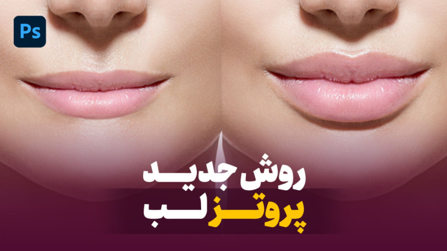 پروتز لب با دو روش حرفه ای در...
