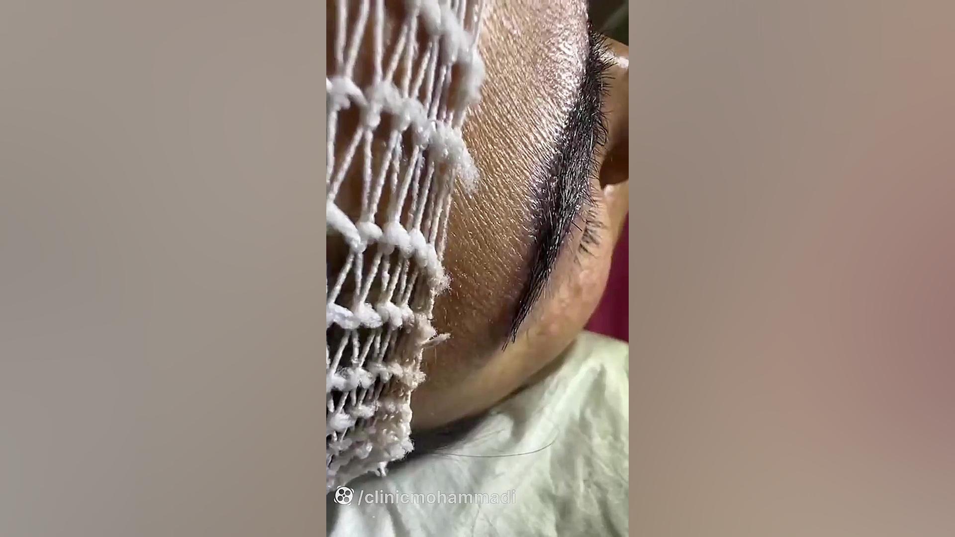 بهترین پزشک کاشت ابرو