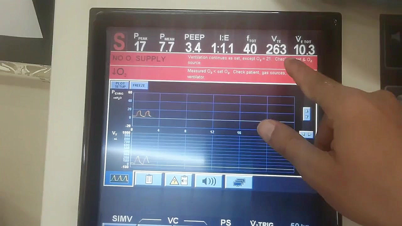 مدهای تهویه مکانیکی 2 SIMV