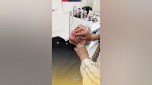 فیلم واقعی تزریق فیلر لب ژل لب...