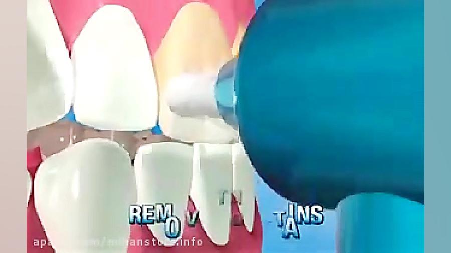 دستگاه سفیدکننده و پولش دندان...