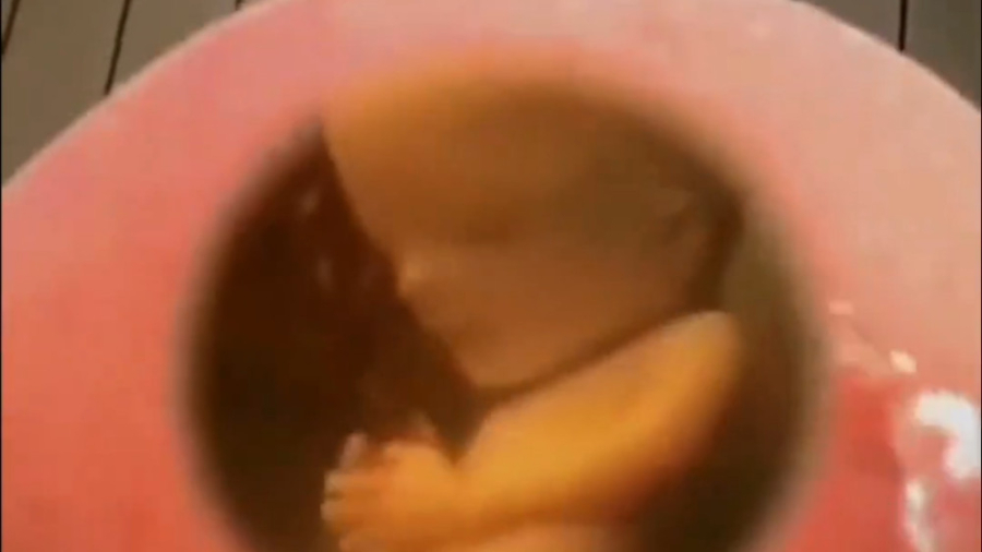 وضعیت جنین در شکم مادر هنگام پ...