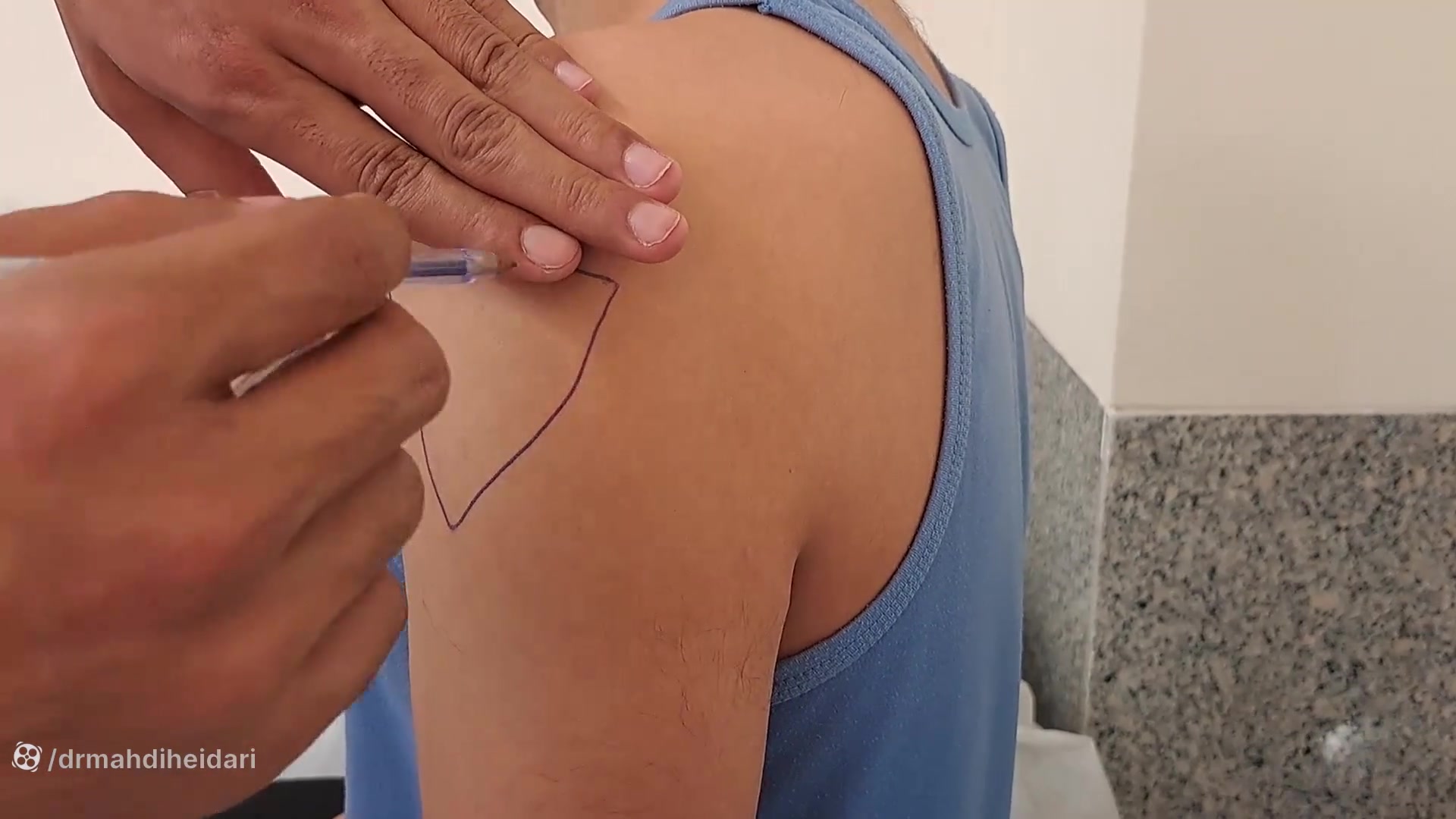 تزریق در عضله بازو(دلتوئید)