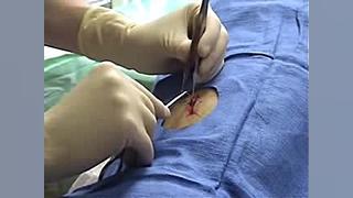 اموزش بخیه زدن زخم