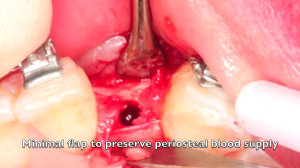 Dental Implant NobelActive