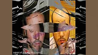 کاشت مو به روش موفق و جدید SUT...