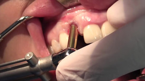 Flapless Dental Implant Remova...