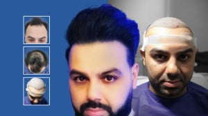 بهترین روش کاشت مو با تراکم با...