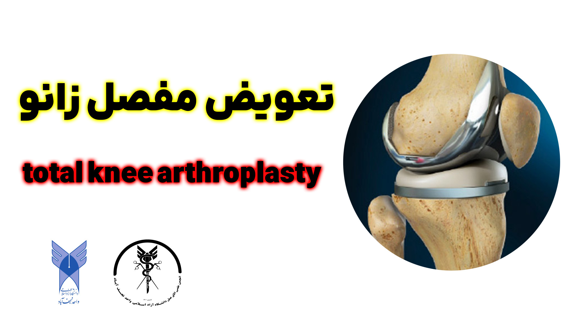 total-knee-arthroplasty