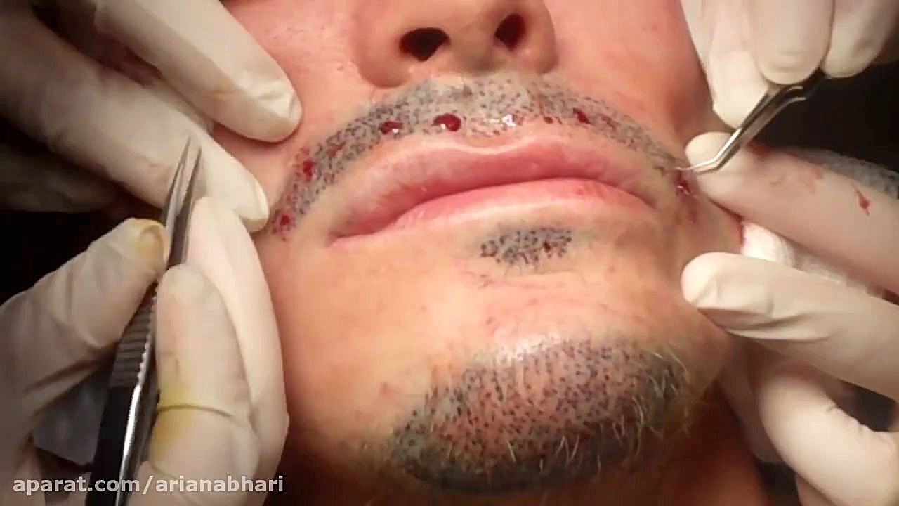 کاشت مو برای سیبیل و ریش در هن...