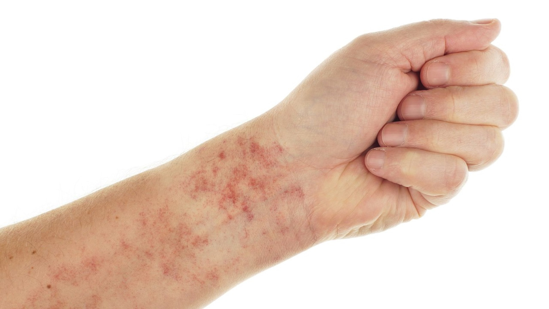 علائم کمبود پلاکت خون