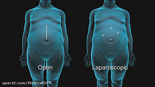 انیمیشن جراحی چاقی