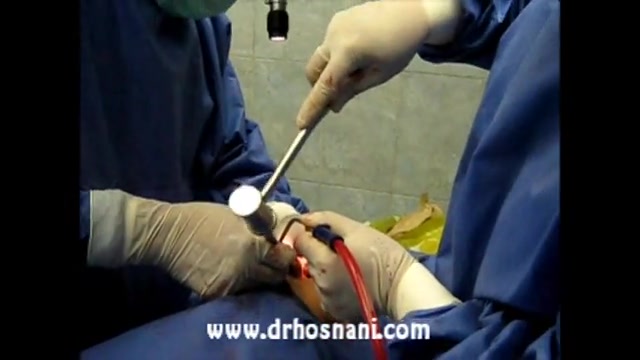 فیلم عمل جراحی بینی دکتر حسنان...