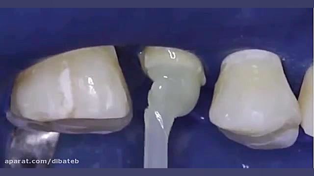 استفاده از پست فایبر با سمان ر...