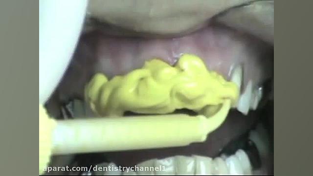 قالبگیری برای ونیرهای دندانی