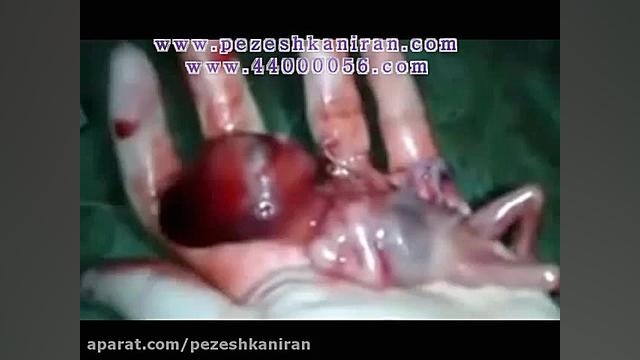 راه های سقط جنین