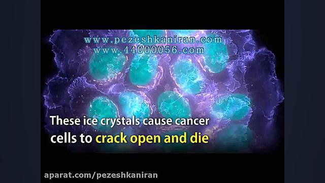 کرایوتراپی در درمان سرطان پستا...