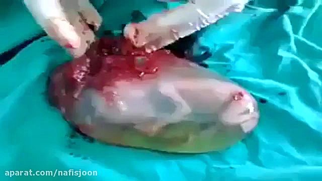 جنین زنده در کیسه آب!