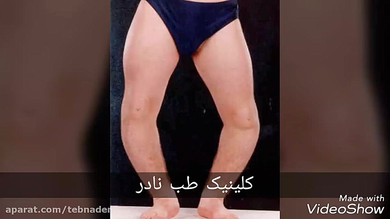 اصلاح زانوی ضربدری بدون جراحی...