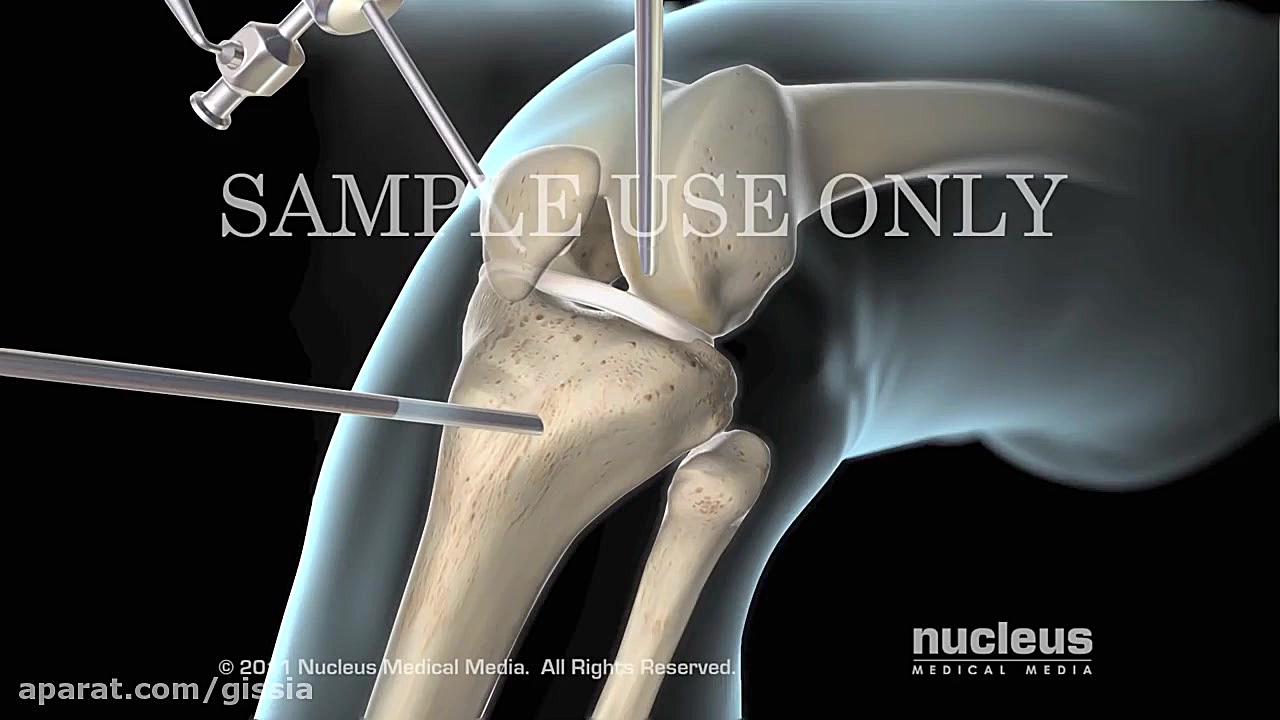 جراحی زانو | زده ACL | سلامت ه...