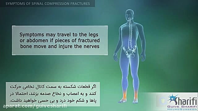 55.نشانه های شکستگی فشاری ستون...